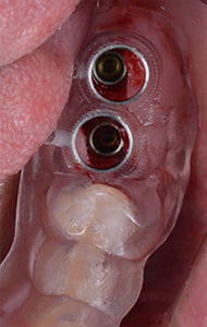 case2 ガイドのインプラント埋入