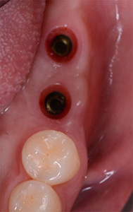 case2 安定した治癒の状態