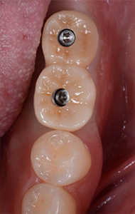 case2 治療終了後