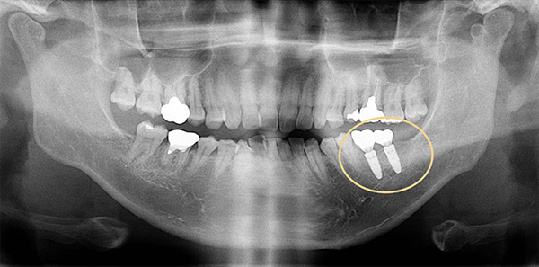 case1 治療終了後