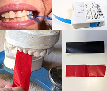 かみ合わせ（咬合）