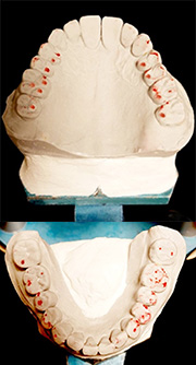 かみ合わせ（咬合）