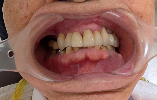 インプラントの長期症例（正面）