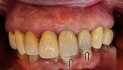 インプラントの長期症例（正面）