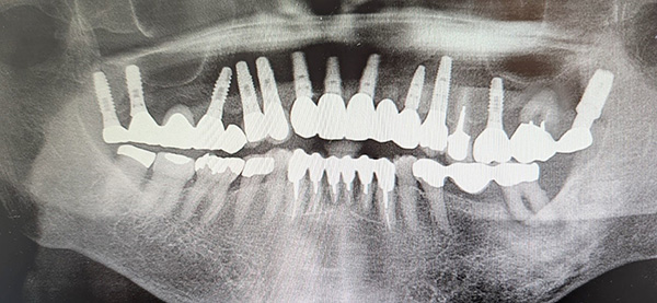 インプラントの長期症例（レントゲン）