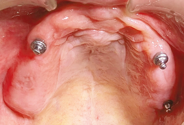 インプラントの長期症例（上顎）