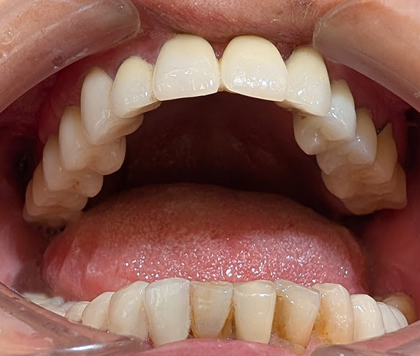 インプラントの長期症例（正面）
