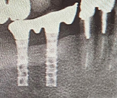 インプラント長期安定性