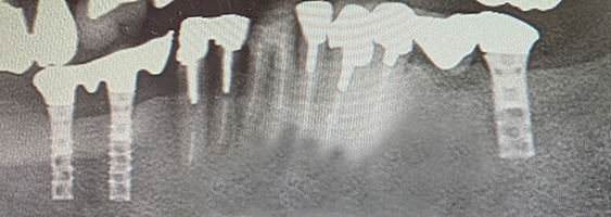 インプラント長期安定性