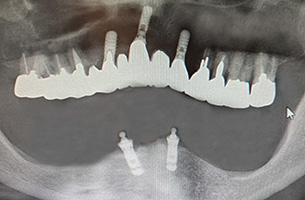 インプラント長期安定性