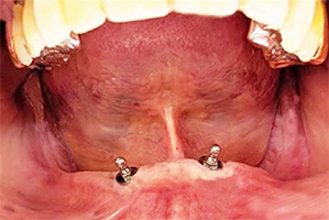 インプラント長期安定性