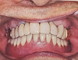 インプラント長期安定性