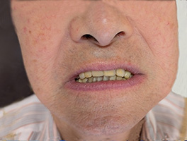 インプラント長期安定性