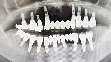 インプラント長期安定性
