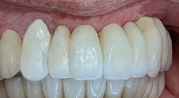 インプラント長期安定性